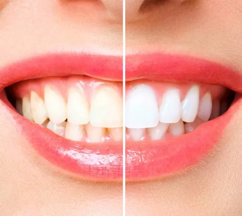 Before and after teeth whitening